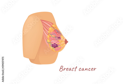 Concept Mammary glands female breast cancer. The illustration is a flat design cartoon concept of a female breast depicting the anatomy of the mammary glands affected by cancer. Vector illustration.