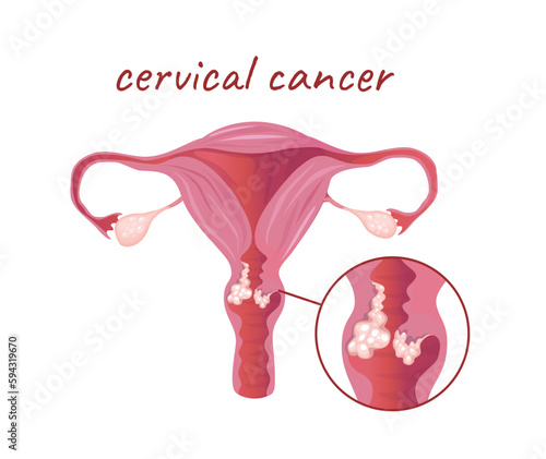 Concept Female anatomy uterus cervical cancer. This illustration depicts a flat, vector, cartoon design of the anatomy of the uterus affected by cancer. Vector illustration.
