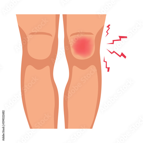 Knee Injury Illustration