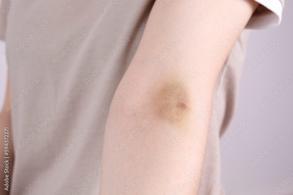 Closeup Female Person Hand With Hematoma, Bruise After Injection, Blood Sampling On Gray Background. Injury, Post-injection phlebitis. Horizontal plane. Closeup Female Person Hand With Hematoma, Bruise After Injection, Blood Sampling On Gray Background. Injury, Post-injection phlebitis. Horizontal plane.