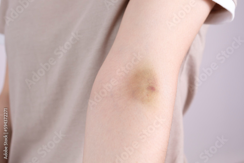 Closeup Female Person Hand With Hematoma  Bruise After Injection  Blood Sampling On Gray Background. Injury  Post-injection phlebitis. Horizontal plane.