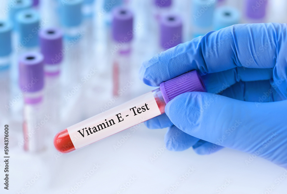 Doctor holding a test blood sample tube with Vitamin E test on the background of medical test tubes with analyzes.Banner.Copy space for text