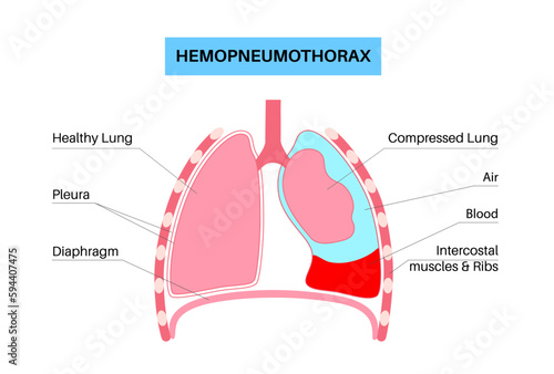 Hemopneumothorax medical poster