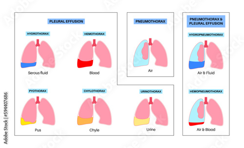 Pleural effusion poster