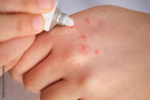 Woman applying white medical corticosteroid ointment on eczema on her hand. Dermatitis, allergy, psoriasis concept. photo