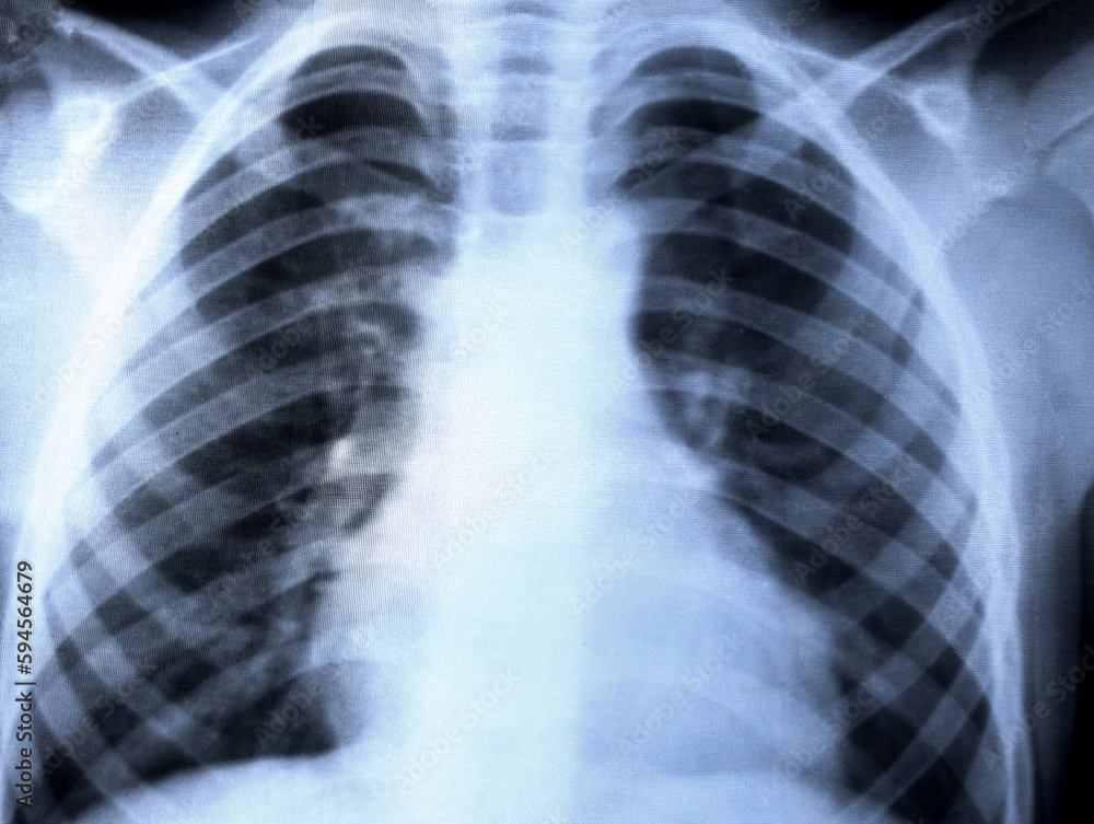 Closeup chest xray. Chest xray for the diagnosis of lung diseases. X
