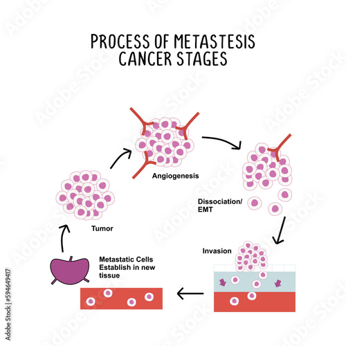 process of metastases cancer stages illustration isolated on white background.