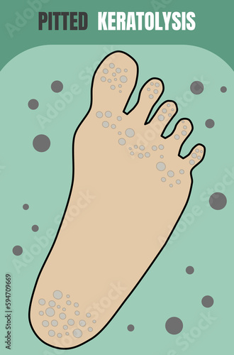 Bacterial infection the skin on feet that like pits and malodour