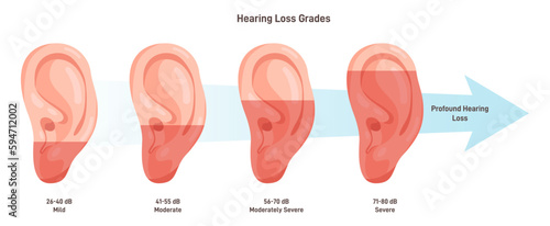Hearing loss stages. Medical diagnosis of hearing system disease