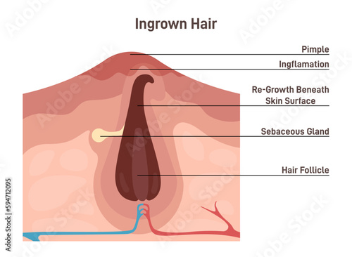 Ingrown hair, dermatology problem when hair has grown back into the skin.