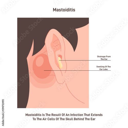 Mastoiditis. Inflammatory disease of the ear. Bacterial mastoid