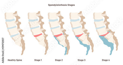 Spondylolisthesis. Spinal disease when lower vertebrae slip forward
