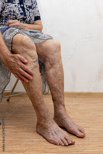 Cropped elderly woman showing by hand bare legs with varicose veins inflammation. Need laser surgery operation for medical condition. Checking health for thrombosis, thrombophlebitis, embolism issue