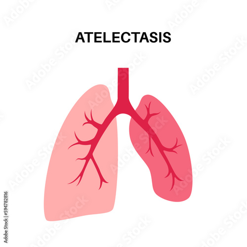 Atelectasis medical poster