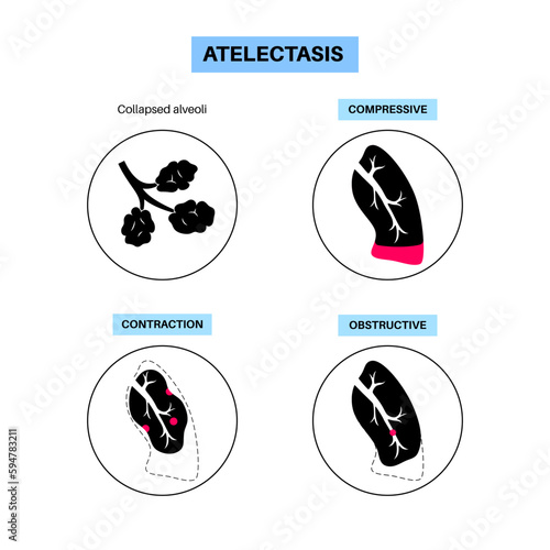 Atelectasis medical poster