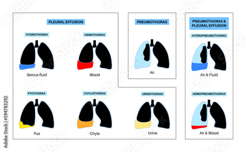 Pleural effusion poster