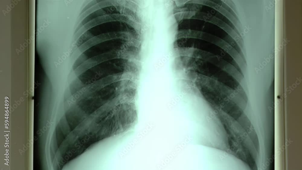 X-ray of Chest, Doctor Examining X-ray of Chest in Hospital. Close Up. X-ray of Chest, Doctor Examining X-ray of Chest in Hospital. Close Up.