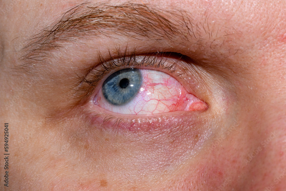 Fototapeta premium Oko patrzące w górę w zbliżeniu z alergią 