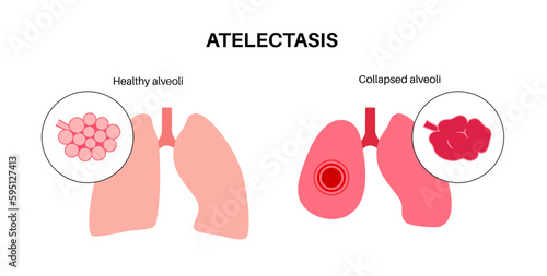 Atelectasis medical poster