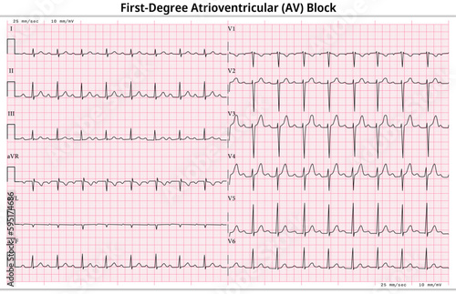 ECG First Degree Atrioventricular Block - 1st degree AV Block - 12 Lead ECG Common Case - 6 Sec/lead - Medical Vector Illustration
