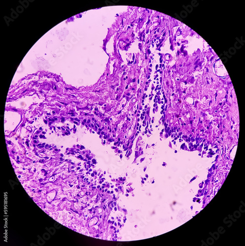 Urethral cyst biopsy, microscopically show cyst wall of fibrocollagenous tissue lined by transitional epithelium. Skene gland cysts. photo