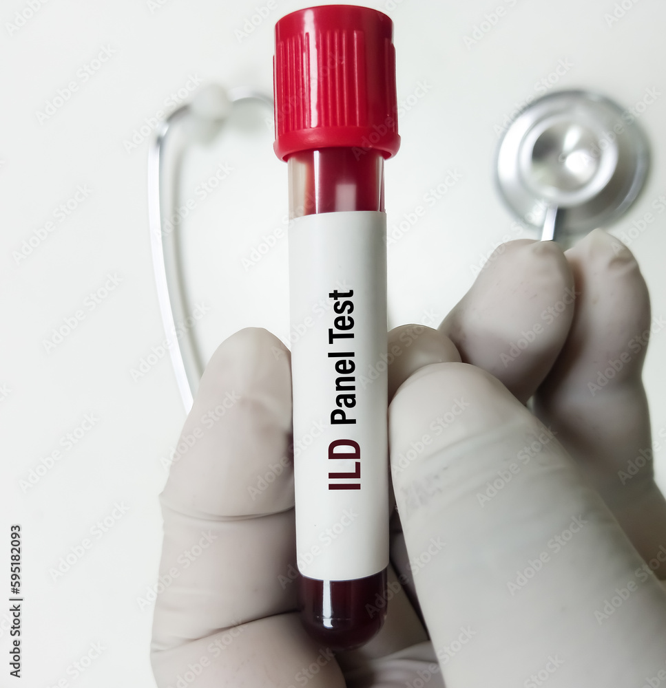 Blood sample for ILD(Interstitial Lung Disease) autoantibody panel test ...