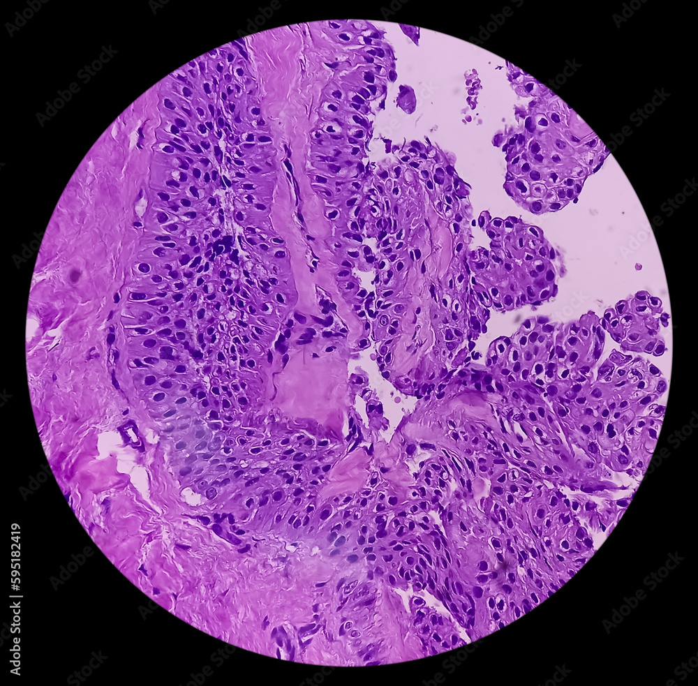 Nodular cystic Hidradenoma. Clear cell hidradenoma, nodular hidradenoma or eccrine acrospiroma, Benign skin tumor, rare benign neoplasm. solid-cystic hidradenoma. Nodular cystic Hidradenoma. Clear cell hidradenoma, nodular hidradenoma or eccrine acrospiroma, Benign skin tumor, rare benign neoplasm. solid-cystic hidradenoma.