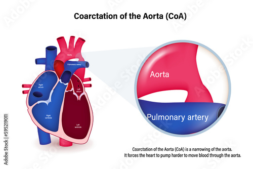 Coarctation of the Aorta vector. Congenital heart disease. 