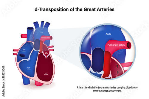 Transposition of the Great Arteries vector. Congenital heart disease. 