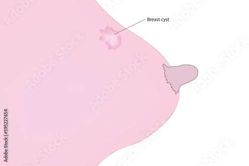 breast cyst