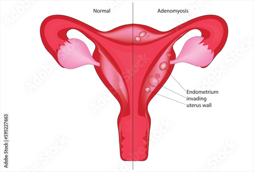 Adenomyosis
