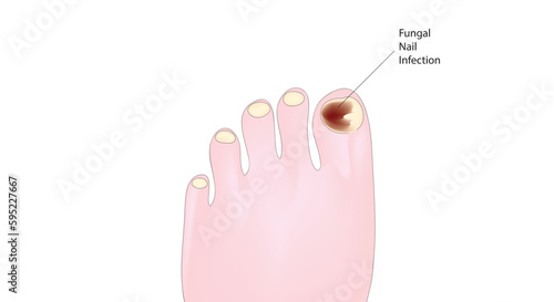 fungal nail infections, fungal nail infection, eczema, dermatitis, inflammation, nail plate, onychogryphosis, illustration, unhealthy, healthy, human, hygiene, problem, sick, feet, toes, psoriasis, de