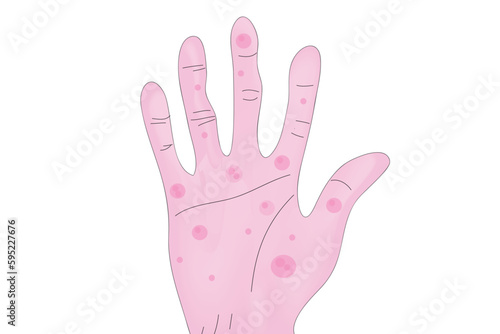 Janeway lesion