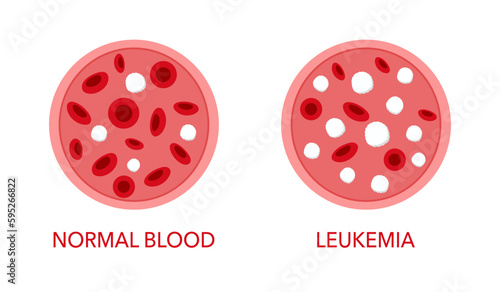 Comparison of normal blood and leukemia in flat design on white background.
