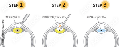 イラスト素材: 白内障手術の流れを図解で説明（主線あり）

