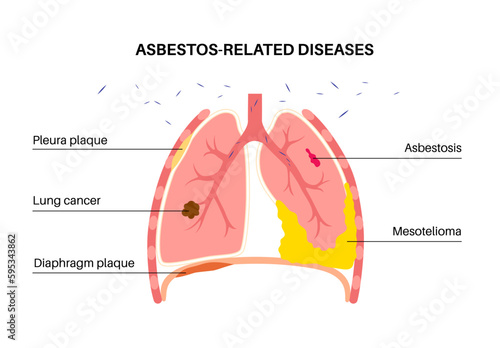 Asbestos related diseases
