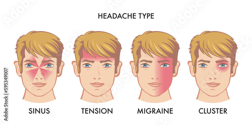 Illustration of types of headache