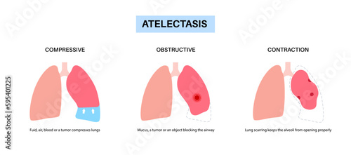 Atelectasis medical poster