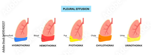Pleural effusion poster