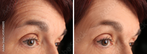 Mature woman before and after skin tightening treatments. Collage with photos on black background, closeup photo