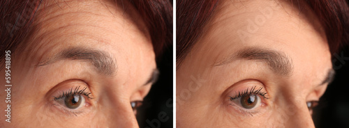 Slika na platnu Mature woman before and after skin tightening treatments