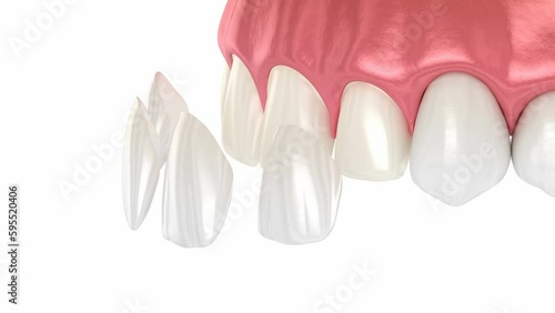 Dental veneer placement procedure. Dental 3D animation