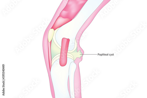 Popliteal cyst photo