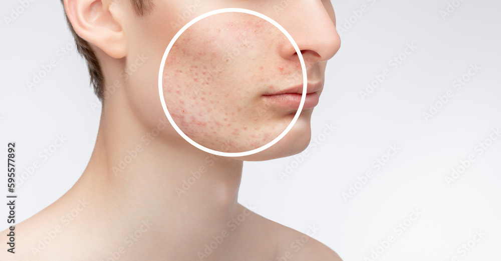 Guy teenager with problem skin on his face. Photos before and after ...