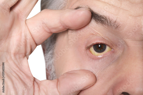 Senior man with yellow eyes on light background, closeup. Symptom of hepatitis