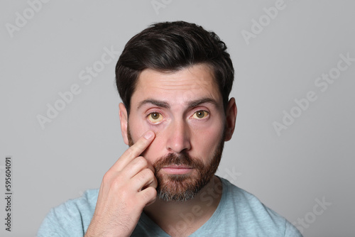 Man with yellow eyes on grey background. Symptom of hepatitis