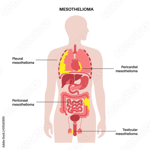 Mesothelioma tumor types