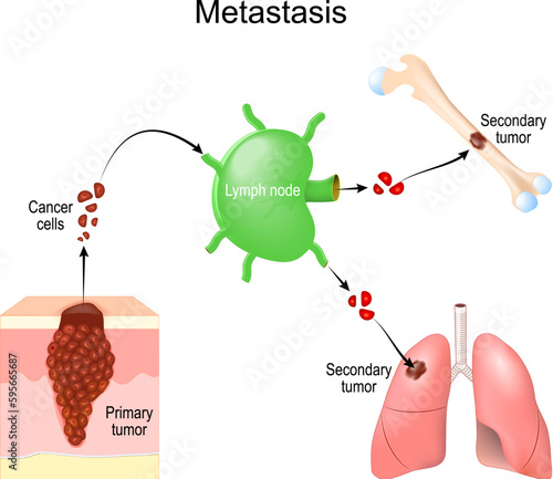 Metastasis. cancer invasion. malignant tumor.