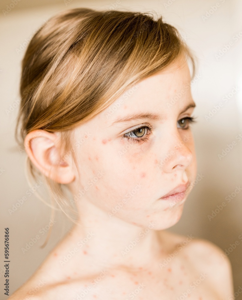 Chickenpox, varicella virus or vesicular rash on little girl body and