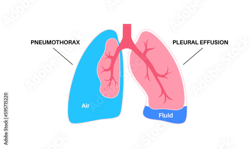 Pleural effusion and pneumothorax
